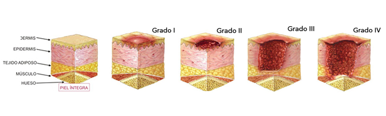 grados-de-las-ulceras-por-presion