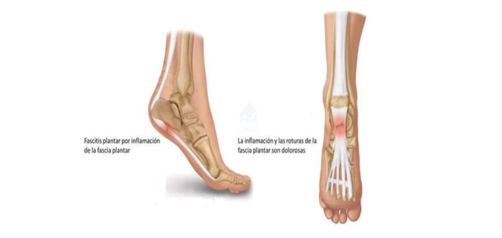 Fascitis plantar: Descubre qué es y cómo se trata