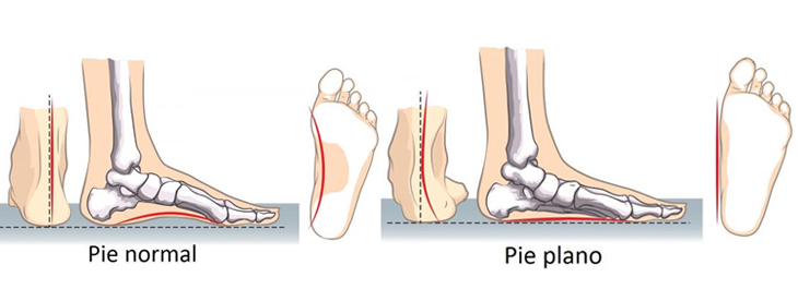 Las Mejores Plantillas para Pies Planos