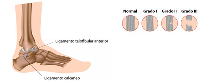 Tobilleras Ortopedicas Para Esguinces