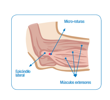 Epicondilitis lateral Epicondilitis lateral