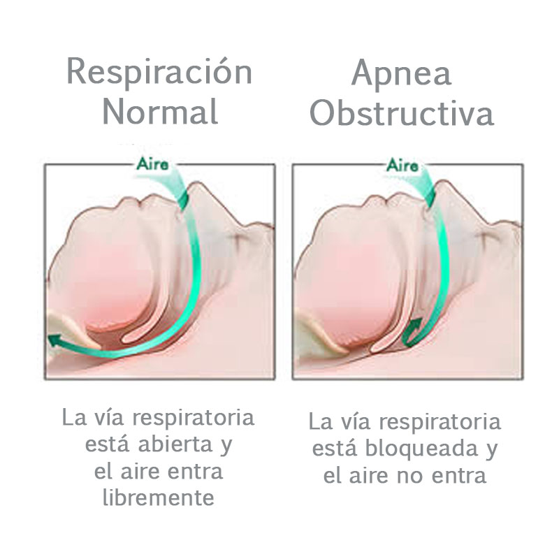 La Apnea Obstructiva del Sueño