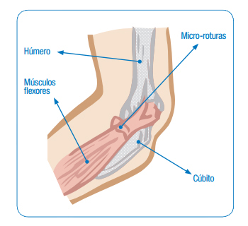 Epicondilitis medial o epitrocleitis Epicondilitis medial o epitrocleitis