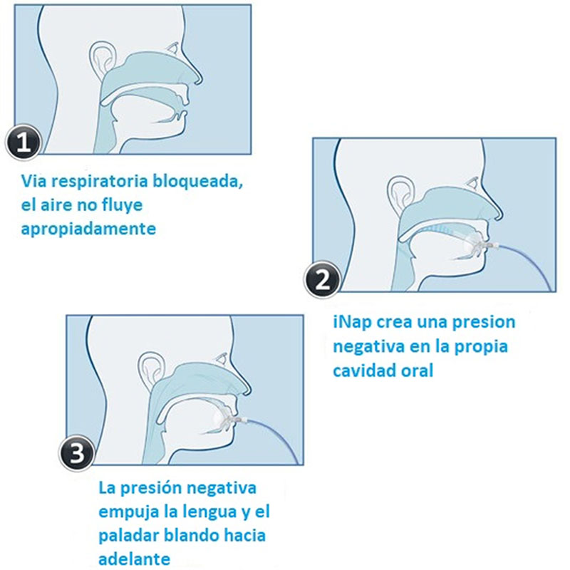 inap-one-equipo-para-apnea-del-sueño